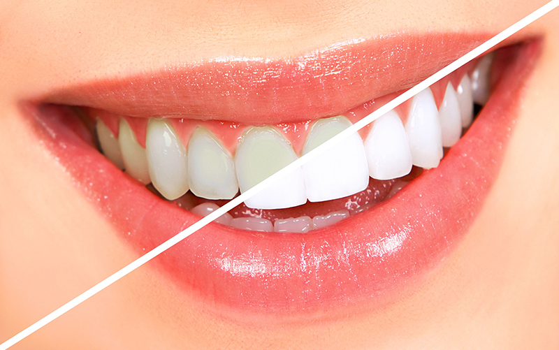 teeth-whitening-methods