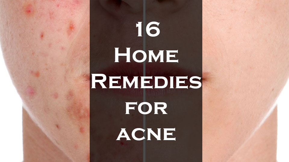 home-remedies-for-acne