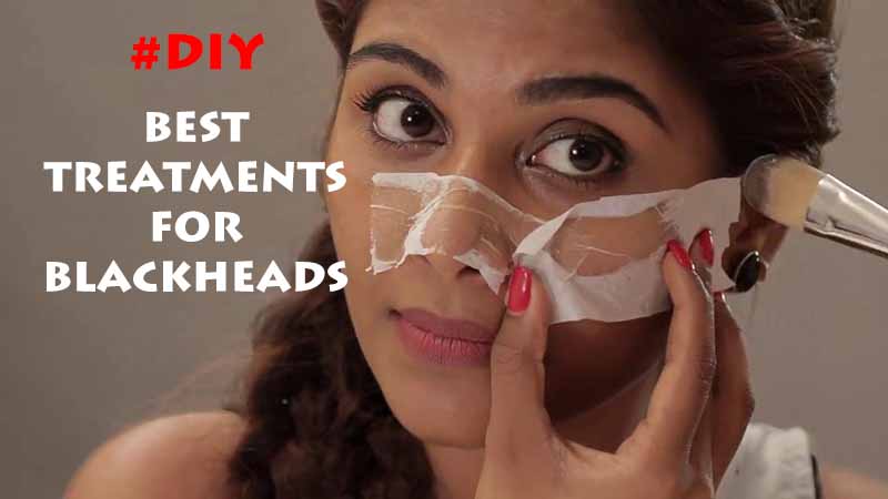 best-treatments-for-blackheads-8